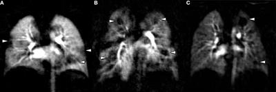 Commentary: Expert Opinion to “Imaging Bronchopulmonary Dysplasia—A Multimodality Update”